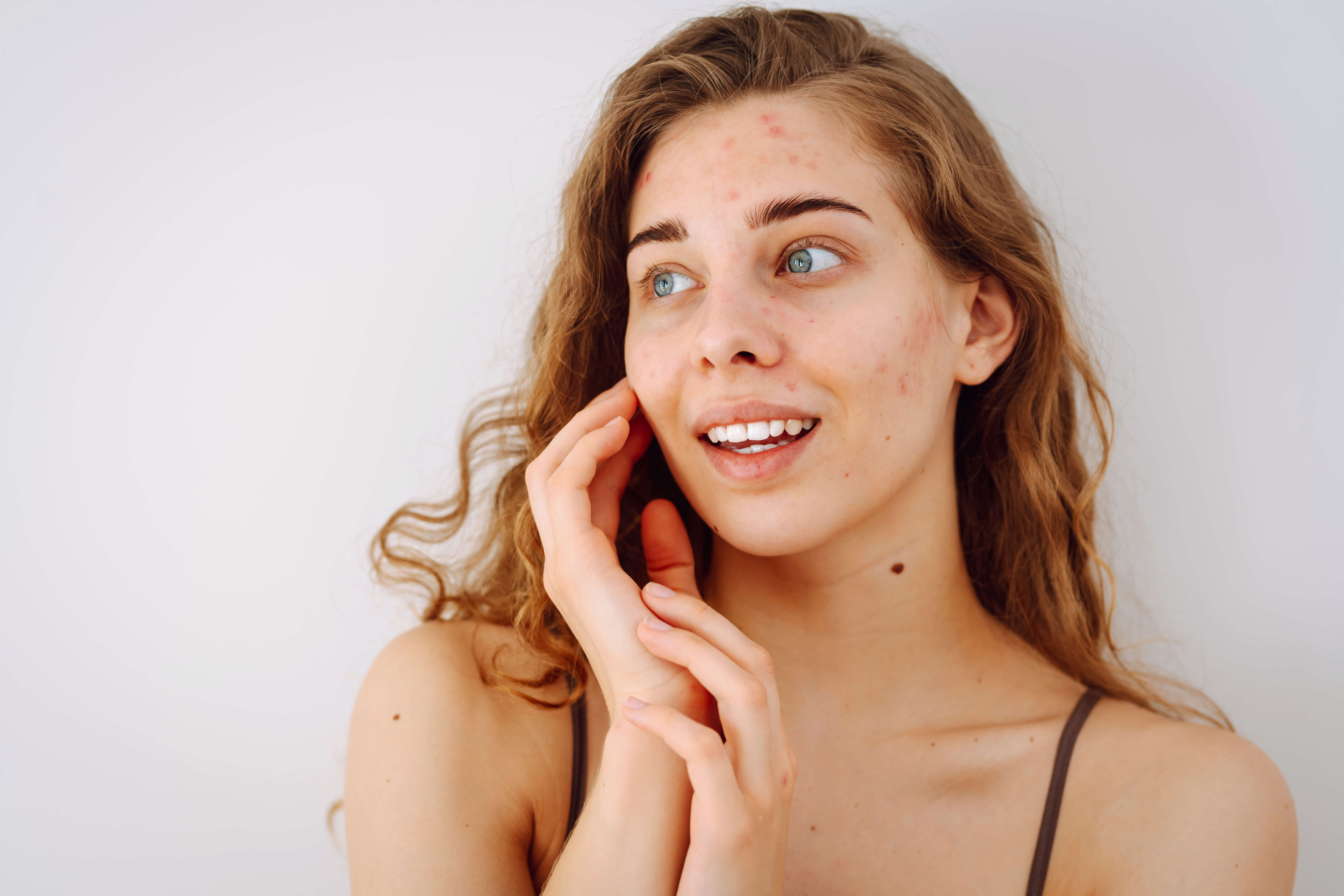 niedoskonałości - skóra 